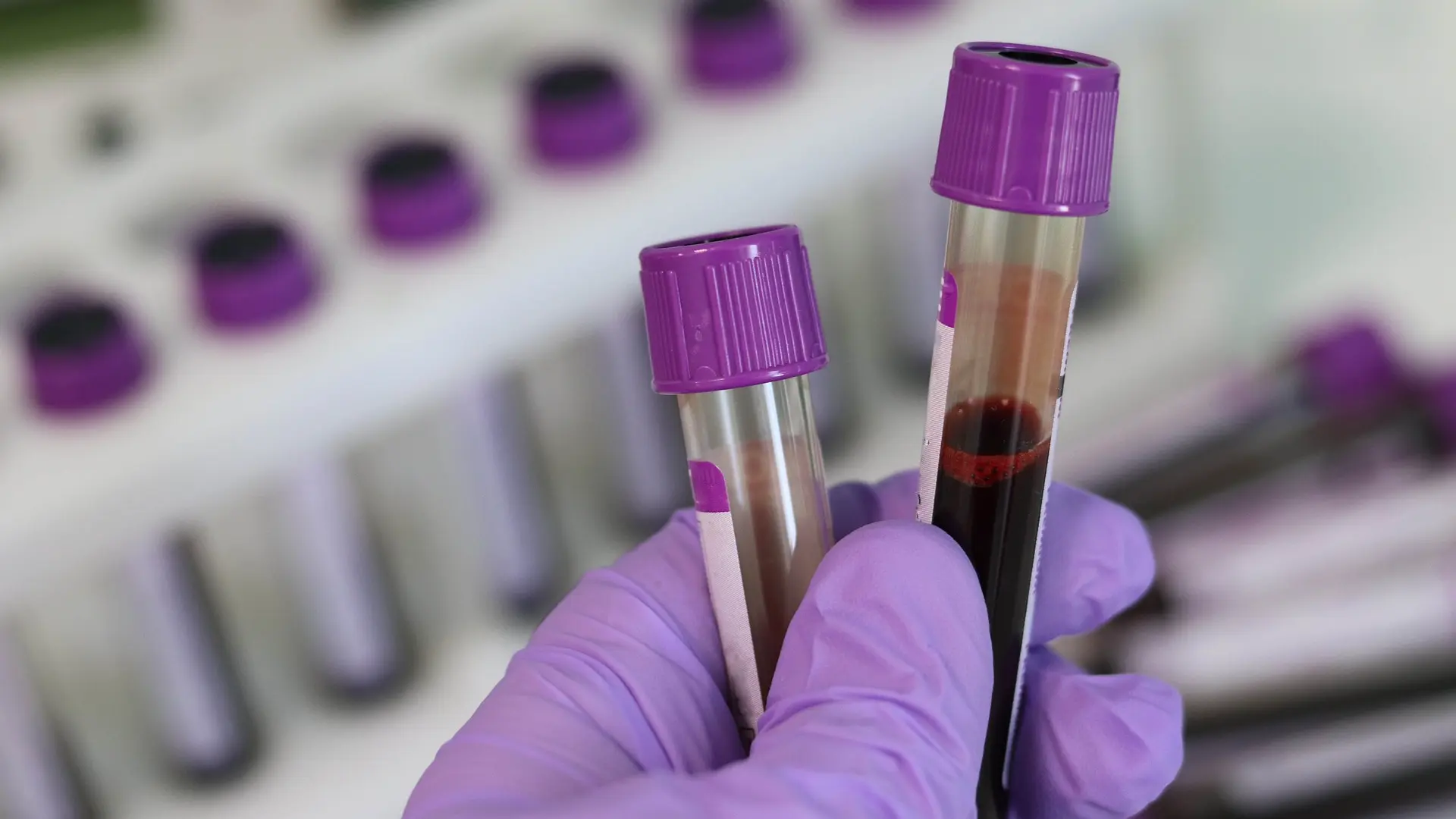 vađenje krvi laboratorija pixabay-6419acc2e6543.webp