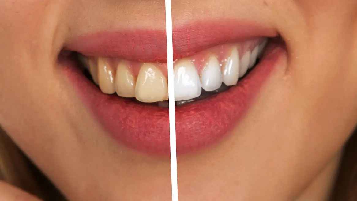 izbeljivanje zuba, zubi, pixabay-665c6c7217c3d.webp